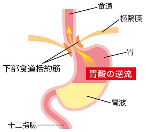 ストレスって関係ある！？逆流性食道炎ってどんな病気？