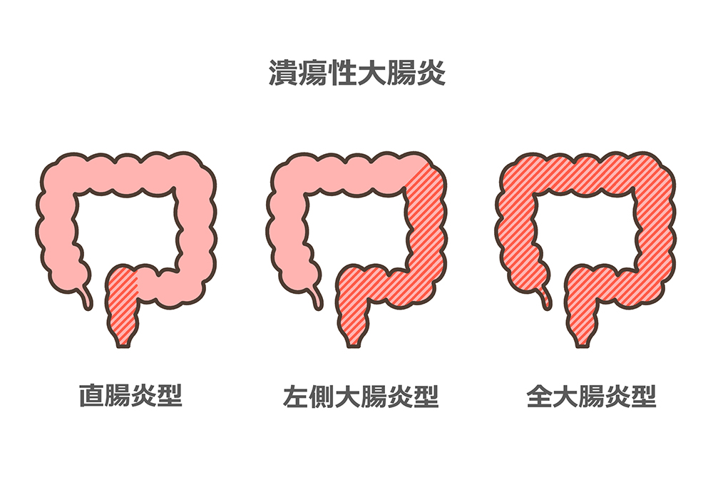 潰瘍性大腸炎とは