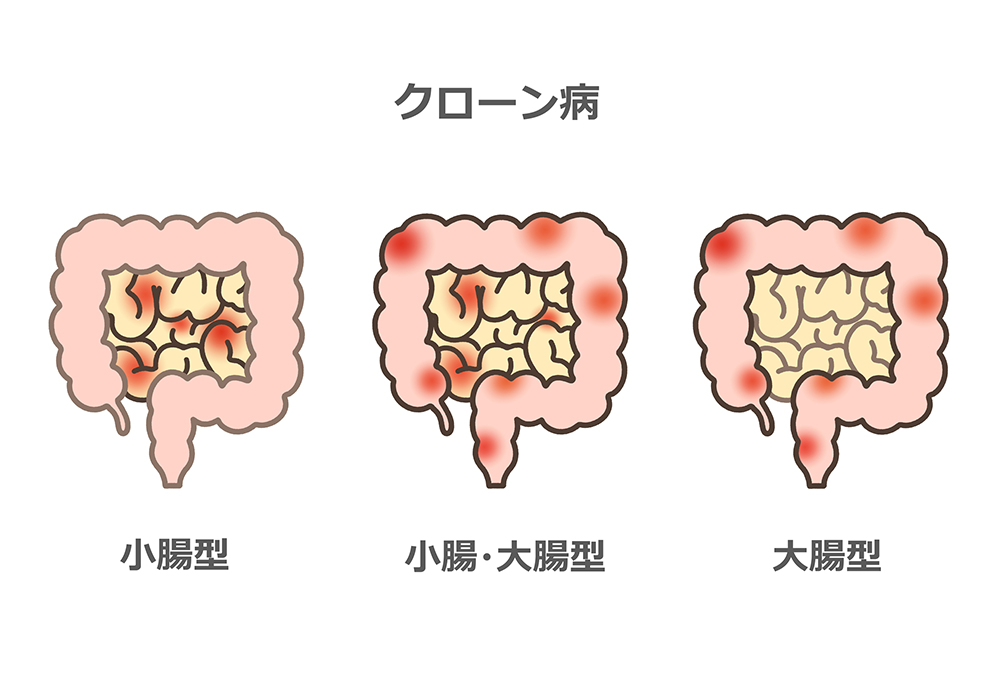 クローン病とは